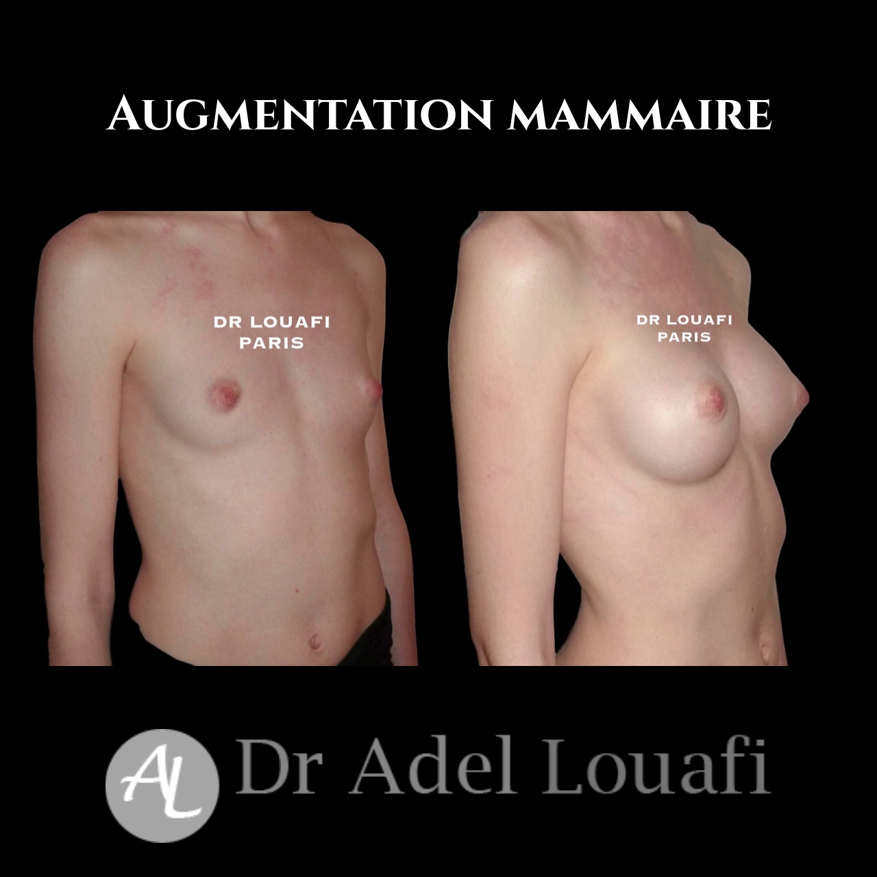 augmentation mammaire photos avant après