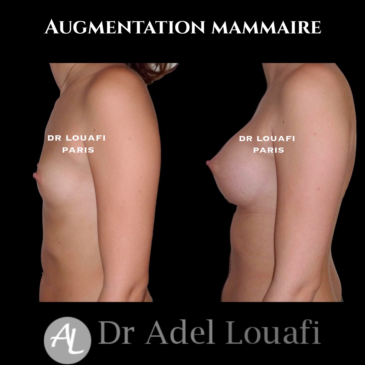 augmentation mammaire avec Dr Louafi