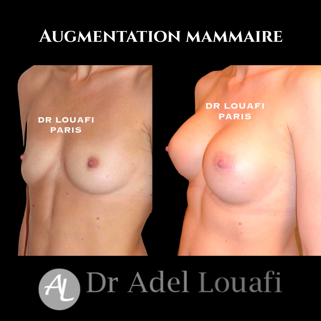 photo augmentation mammaire