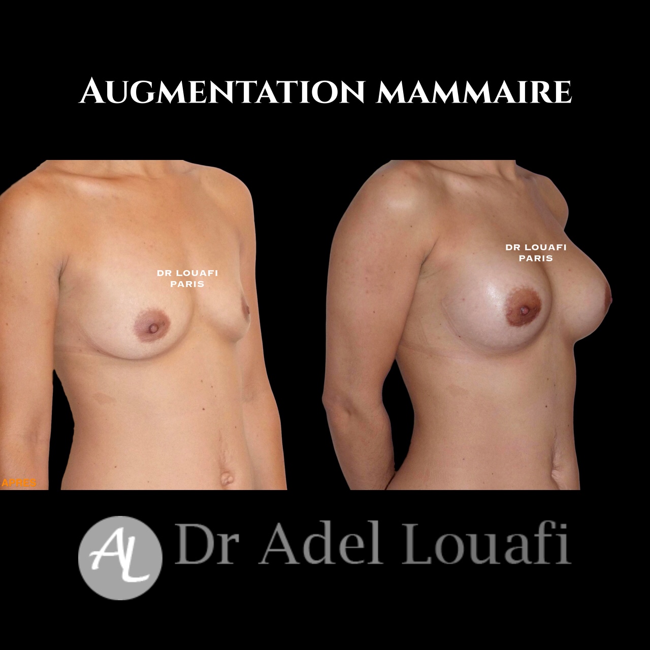 augmentation mammaire photo avant et après l'opération