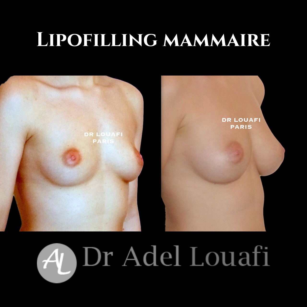 photo avant apres lipofilling mammaire dr louafi