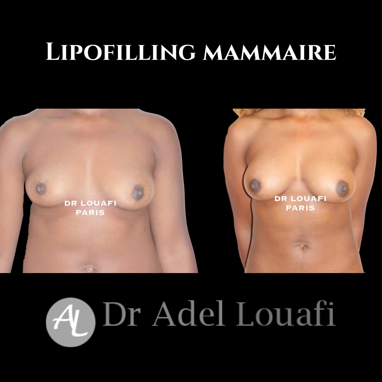 photo lipofilling mammaire dr louafi avant après