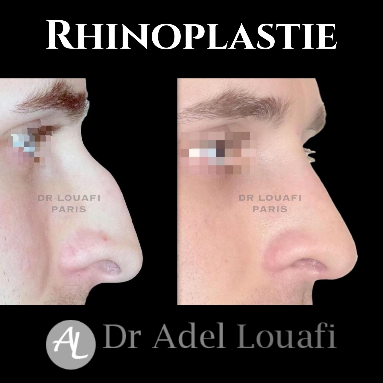 rhinoplastie homme paris