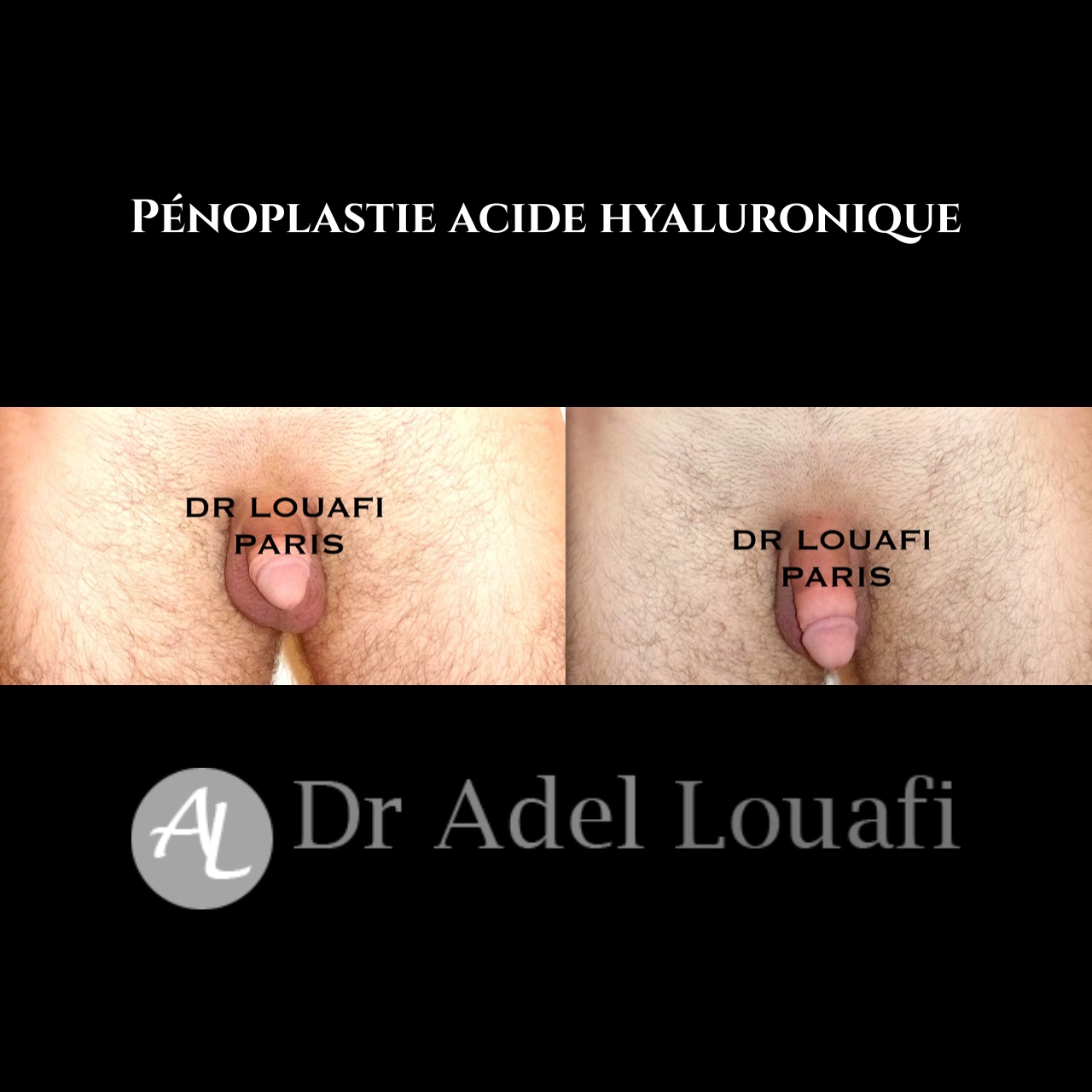 penoplastie à l'acide hyaluronique réalisée par Docteur Louafi