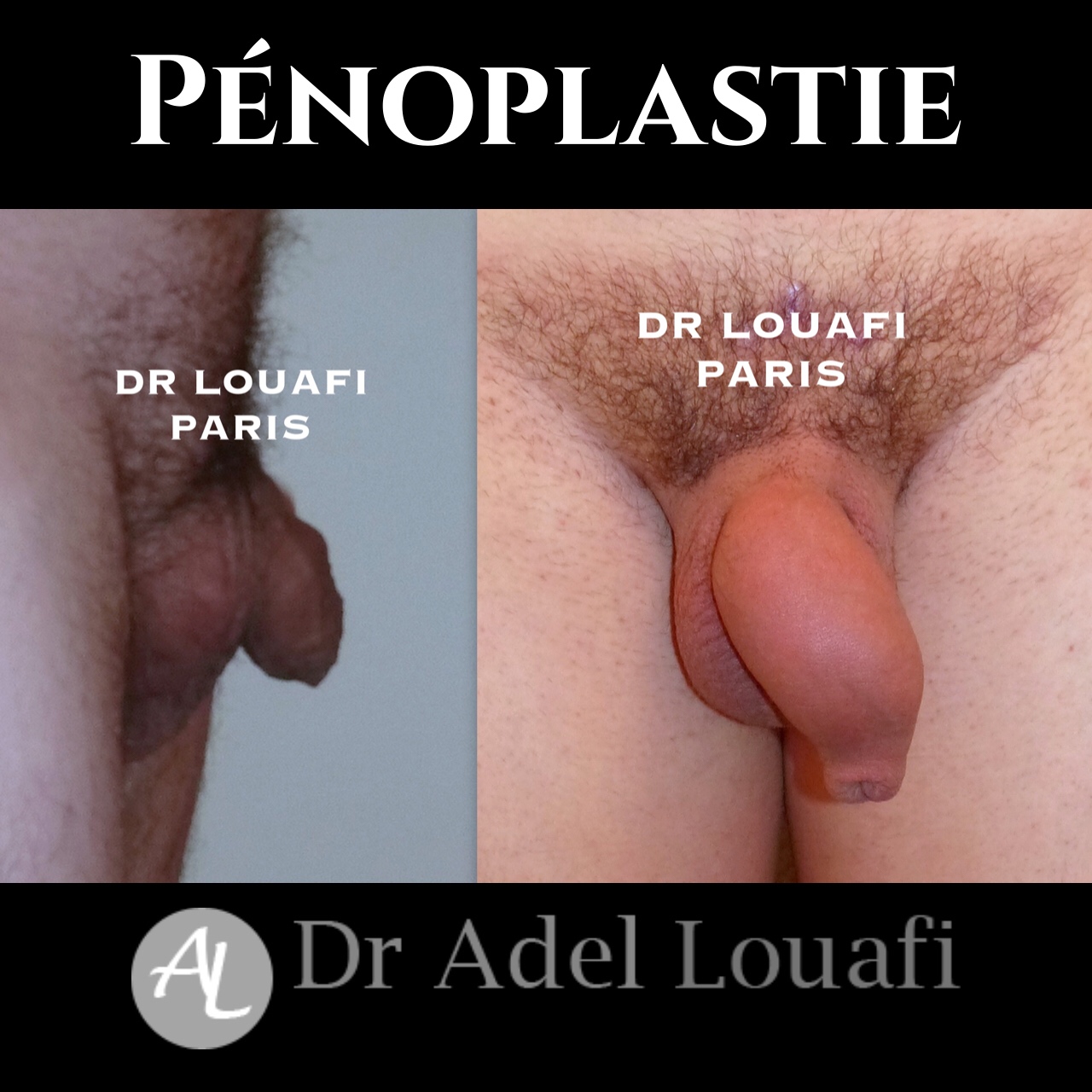 photo avant et après d'un pénoplastie par Dr. Louafi