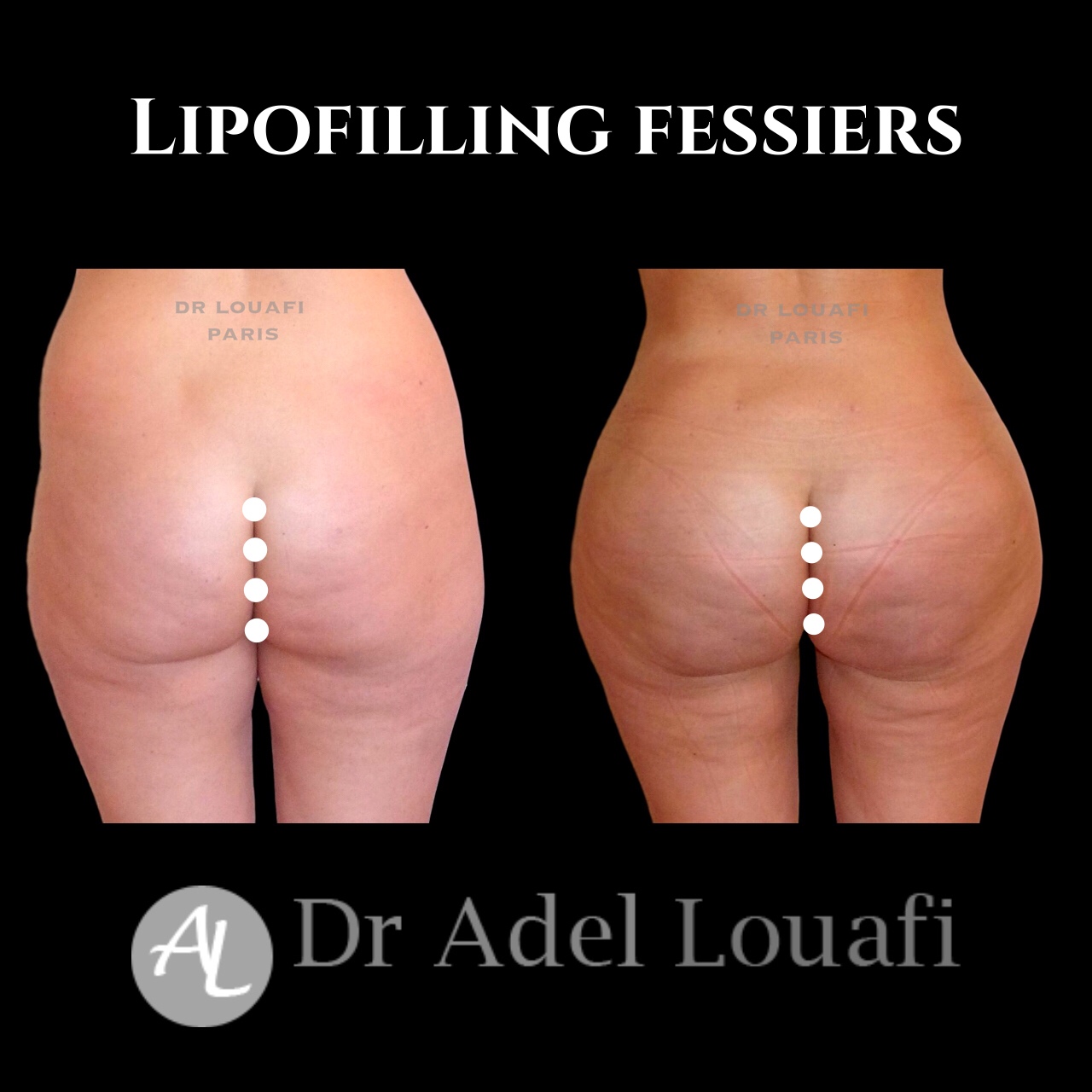 photo lipofilling avant/après