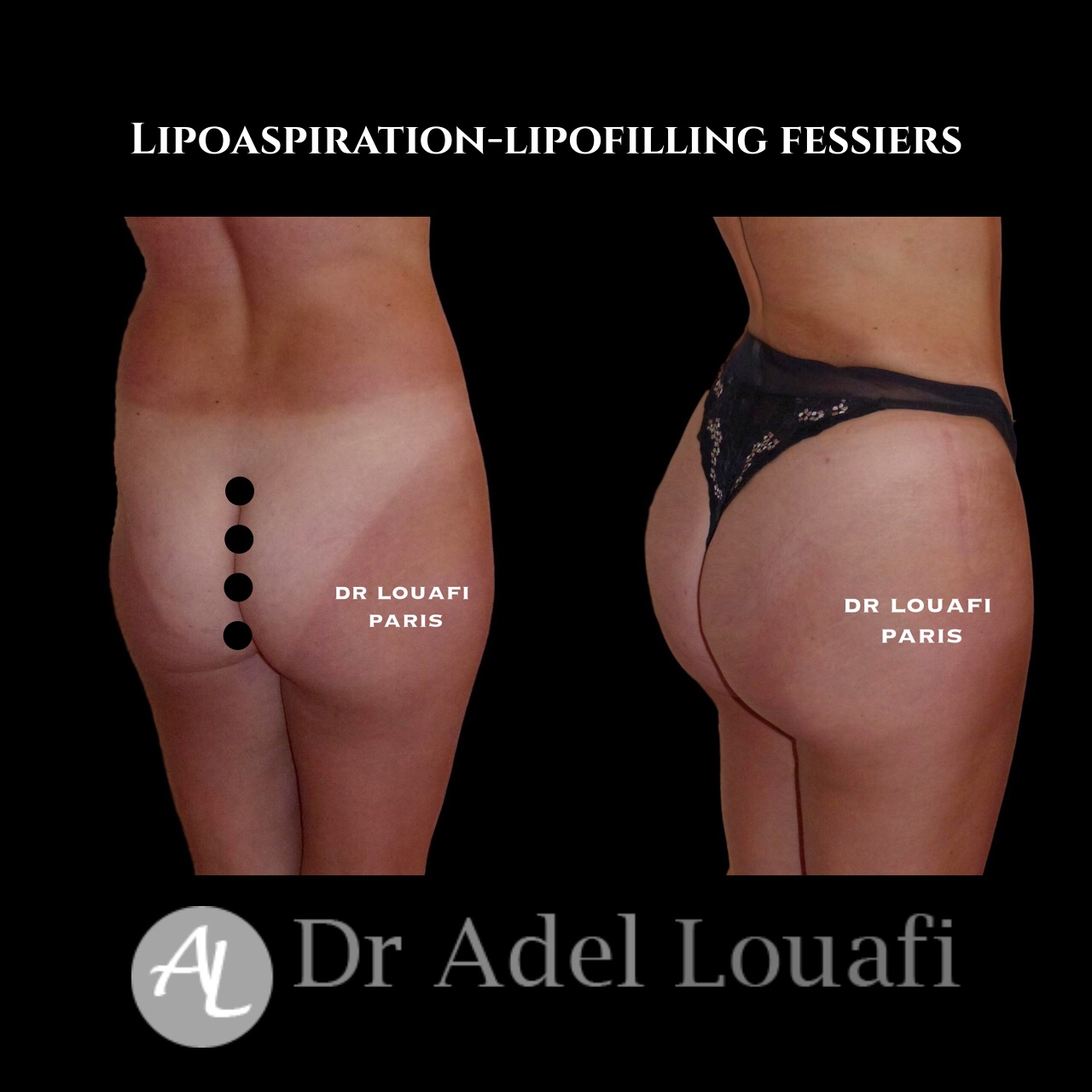 photo avant/après lipoaspiration lipofilling pour fessiers