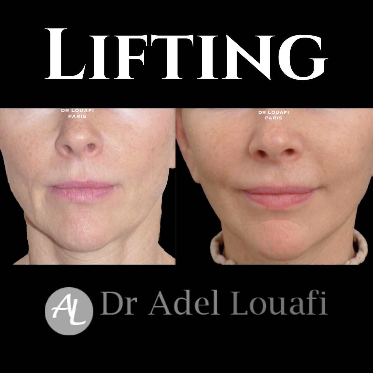 lifting du visage femme avant après