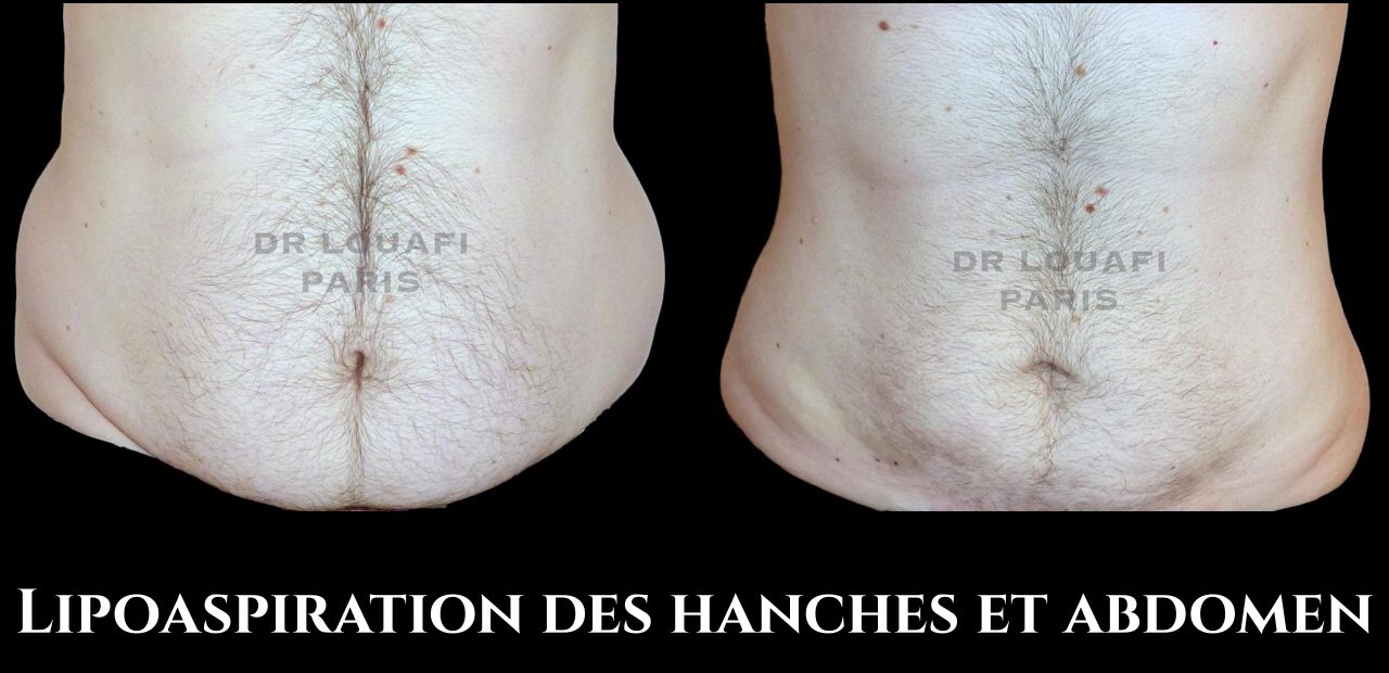 Liposuccion Paris : Lipoaspiration du ventre, cuisses, genoux | Dr Louafi