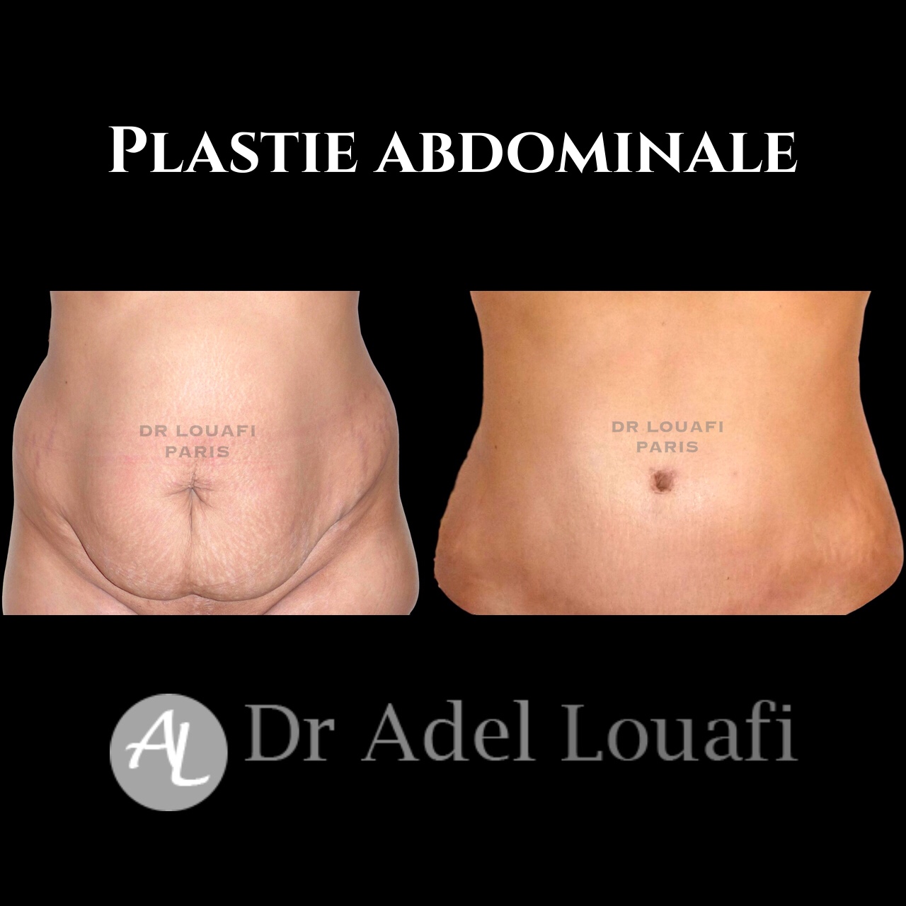 photo plastie abdominale avant après