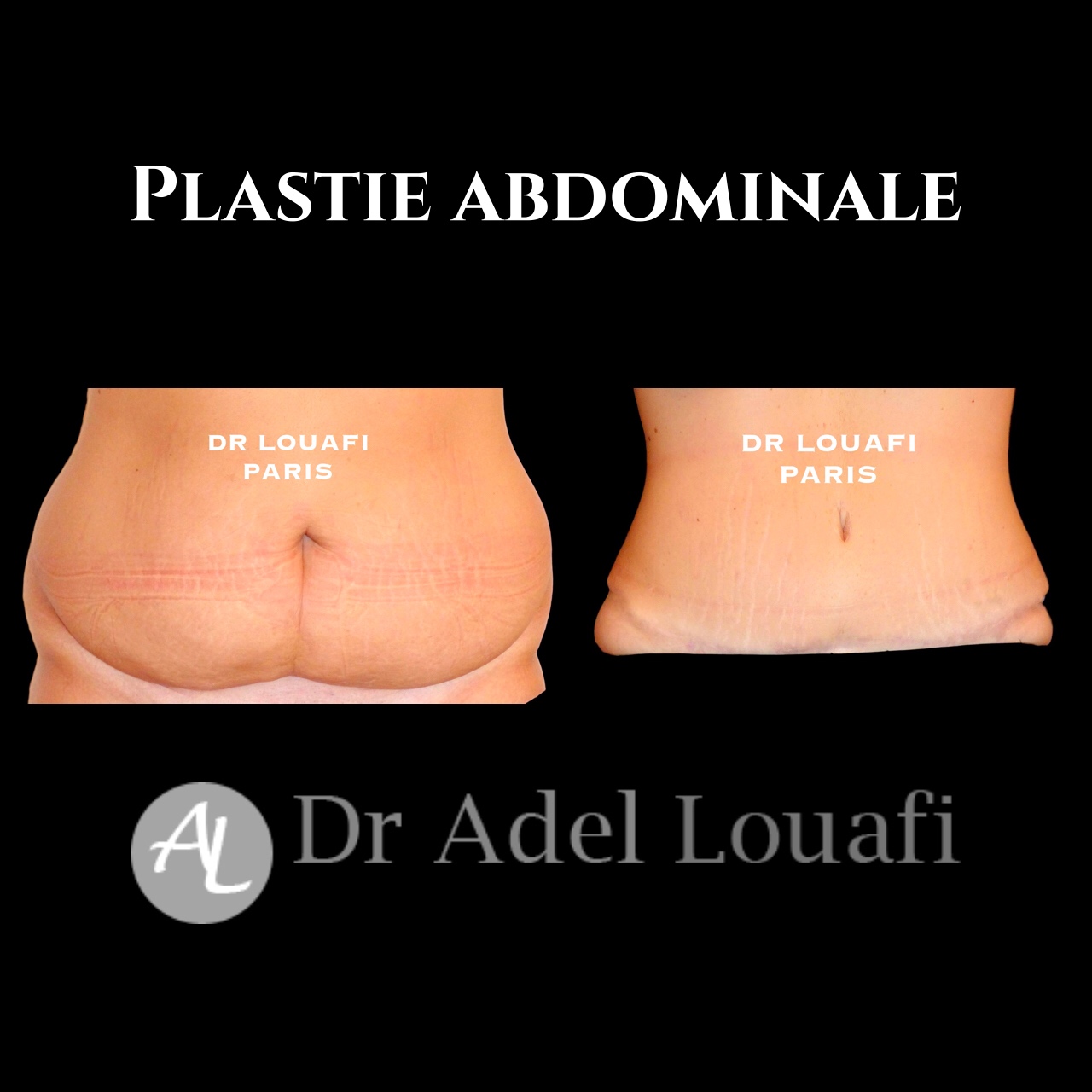 plastie abdominale femme photo avant après