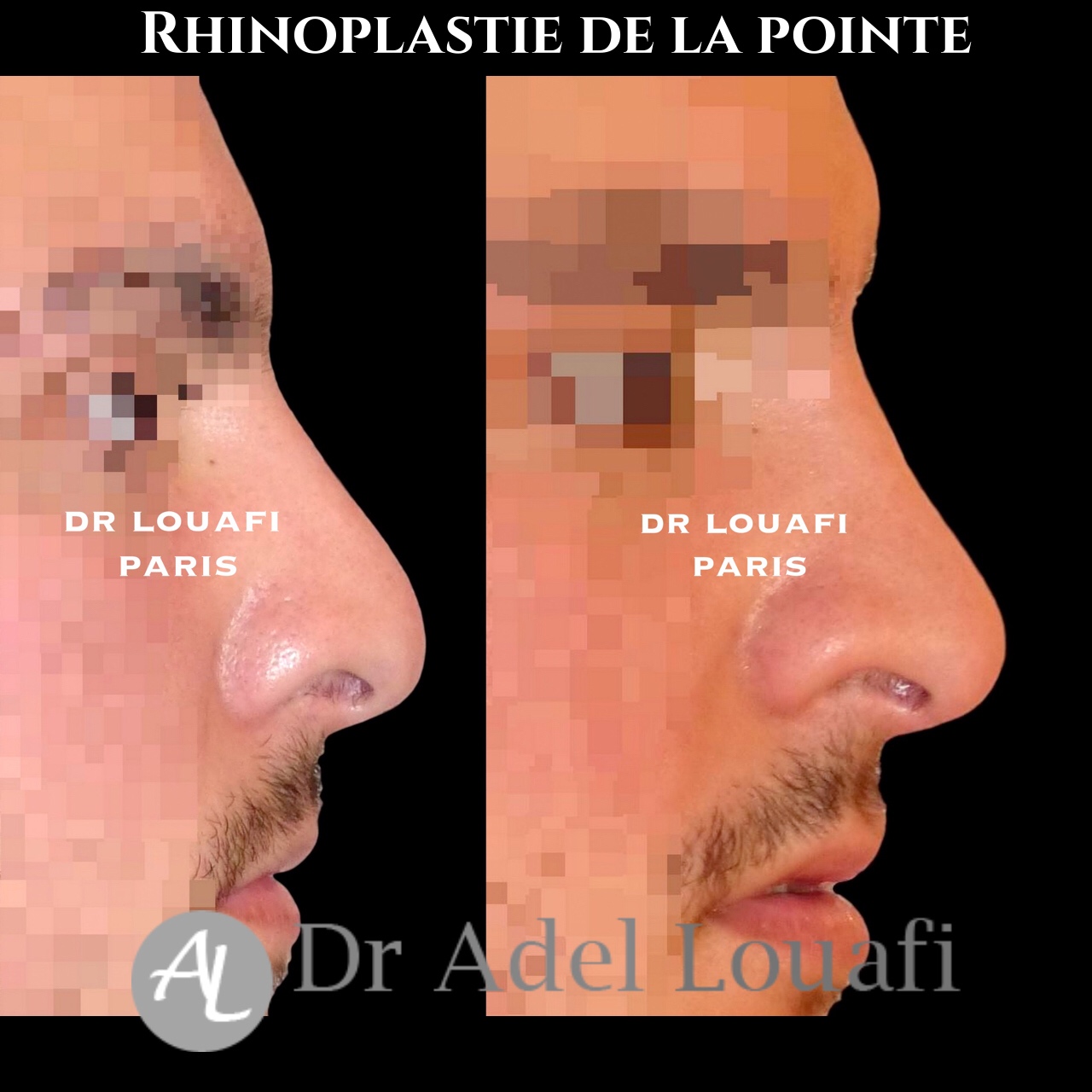 photo avant après rhinoplastie homme