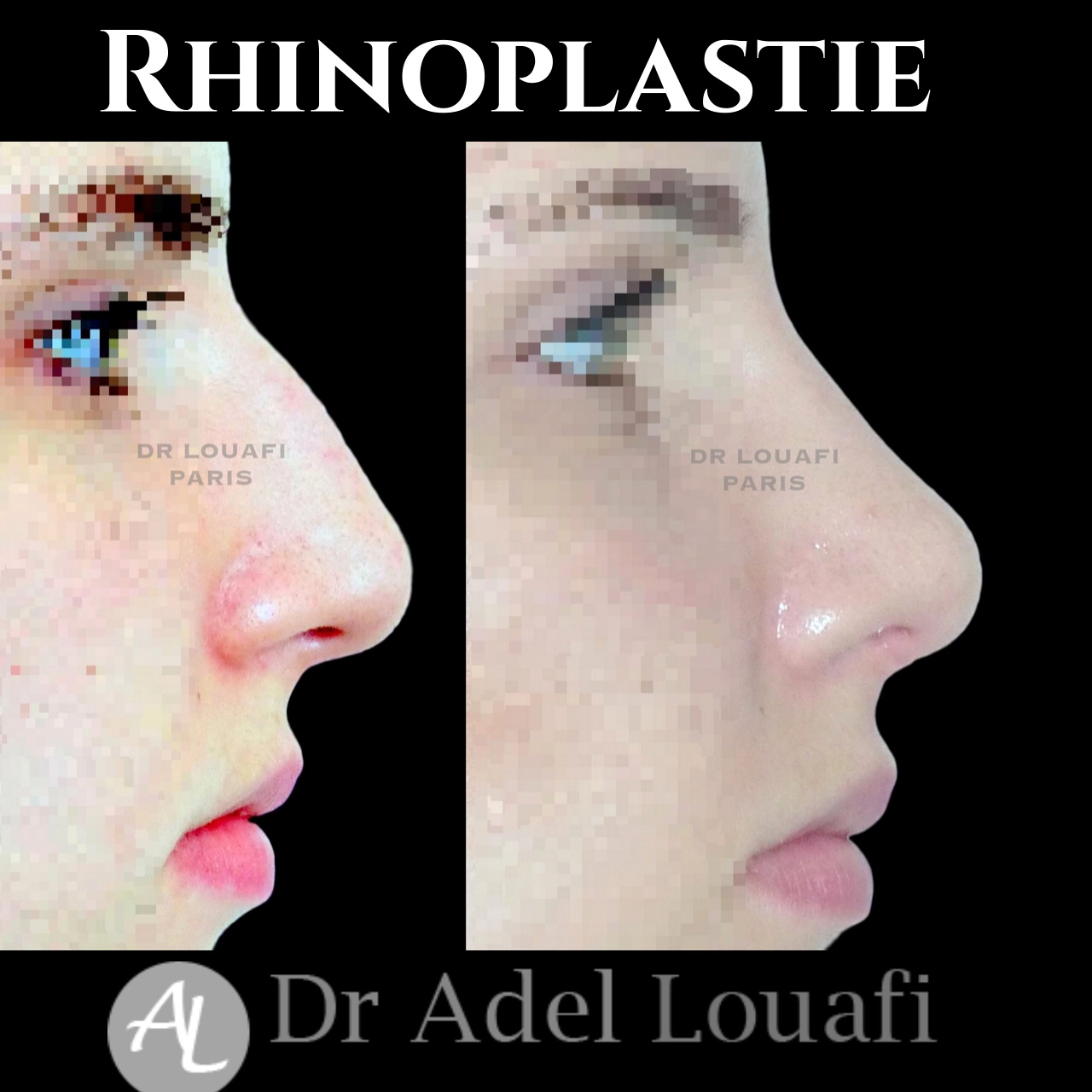 photo avant après rhinoplastie femme louafi