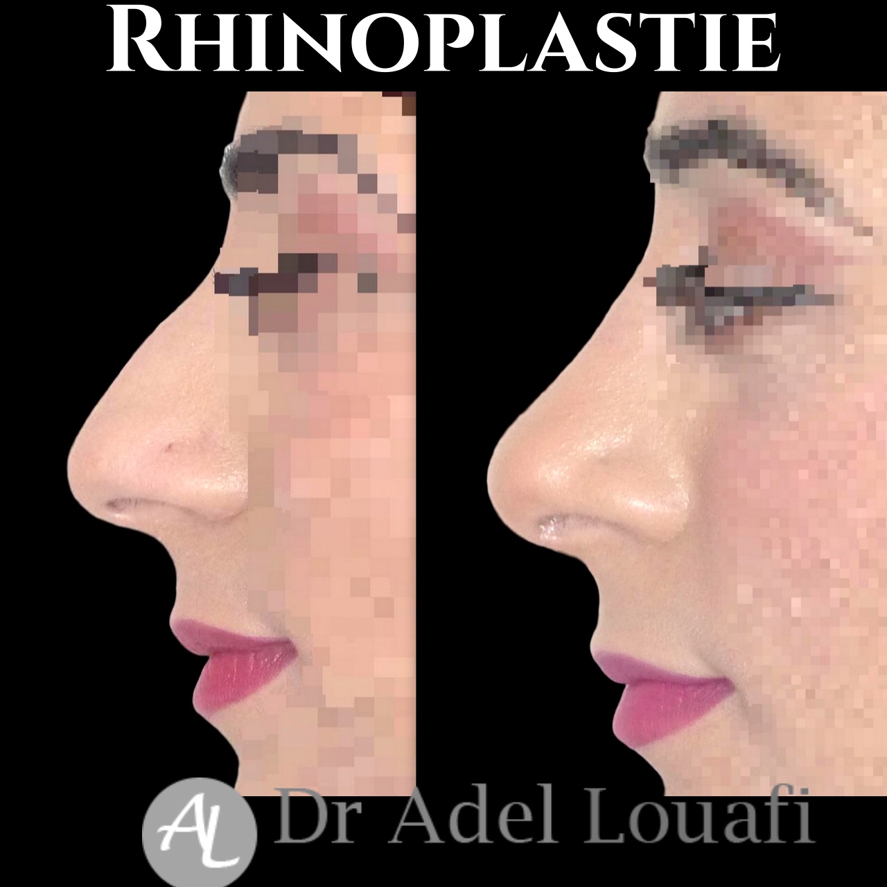 rhinoplastie à Paris femme