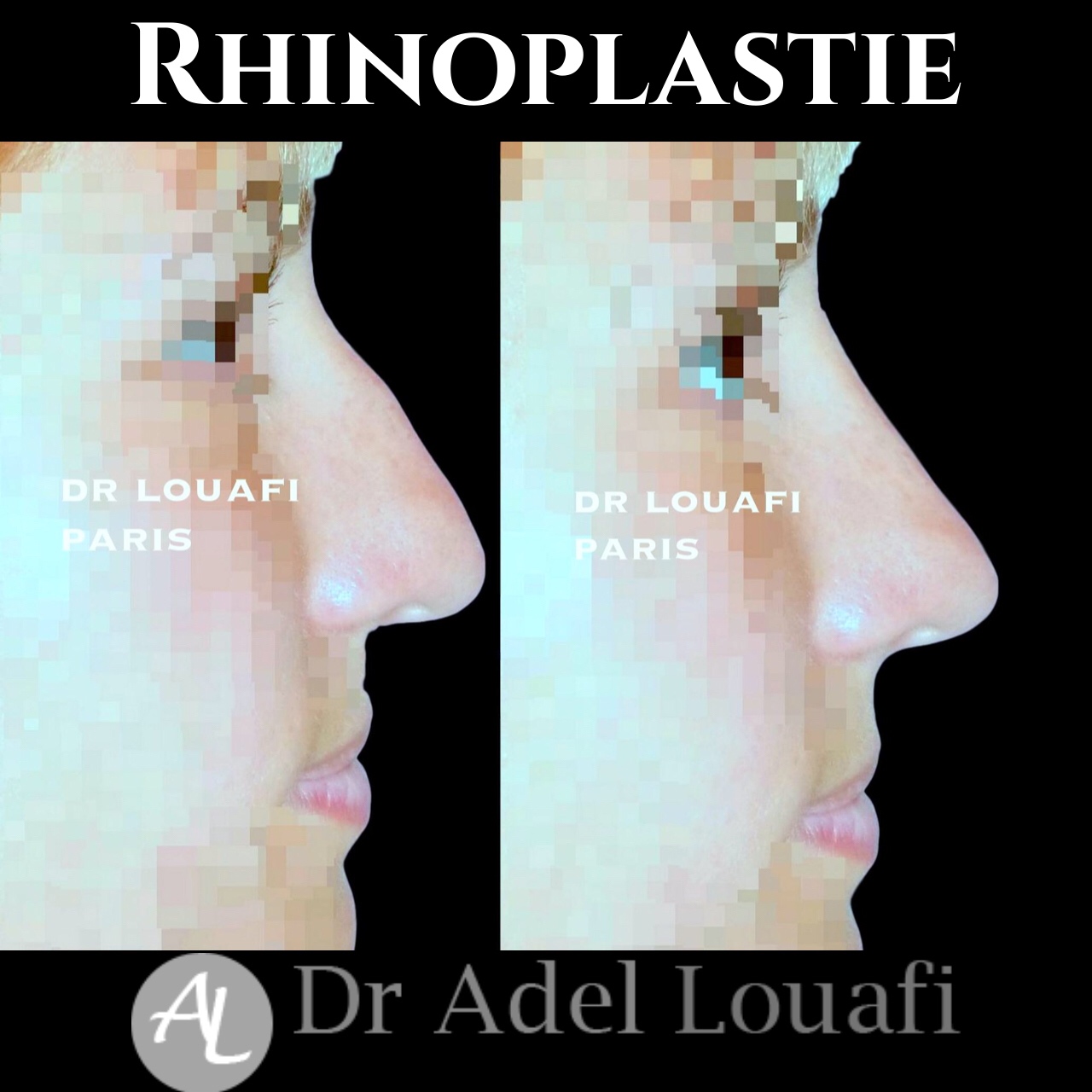 photo rhinoplastie femme dr louafi avant apres