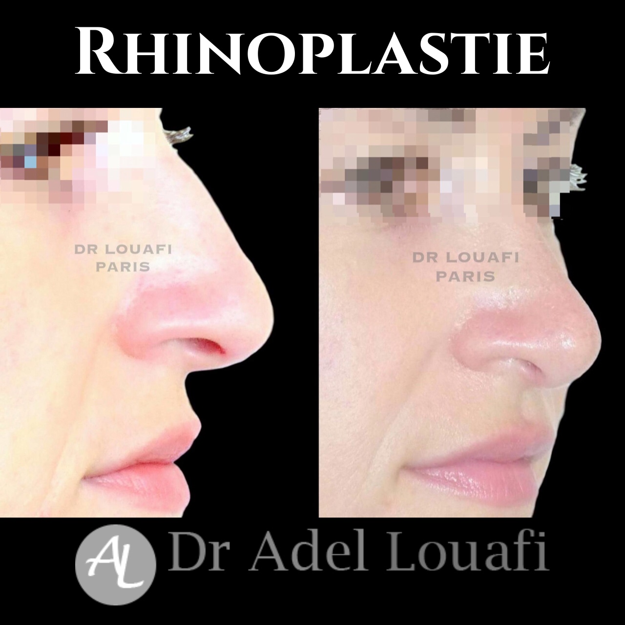 photo avant après rhinoplastie femme dr louafi